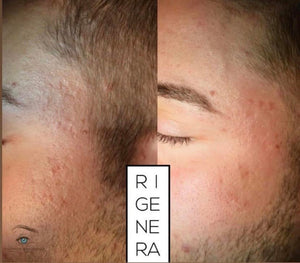 Box di 6 sedute di microneedling full face con aghi specifici per ogni tipo di inestetismo sul volto ( rughe, macchie, macchie solari, cicatrici, pori dilatati) + kit “start” Rigenera